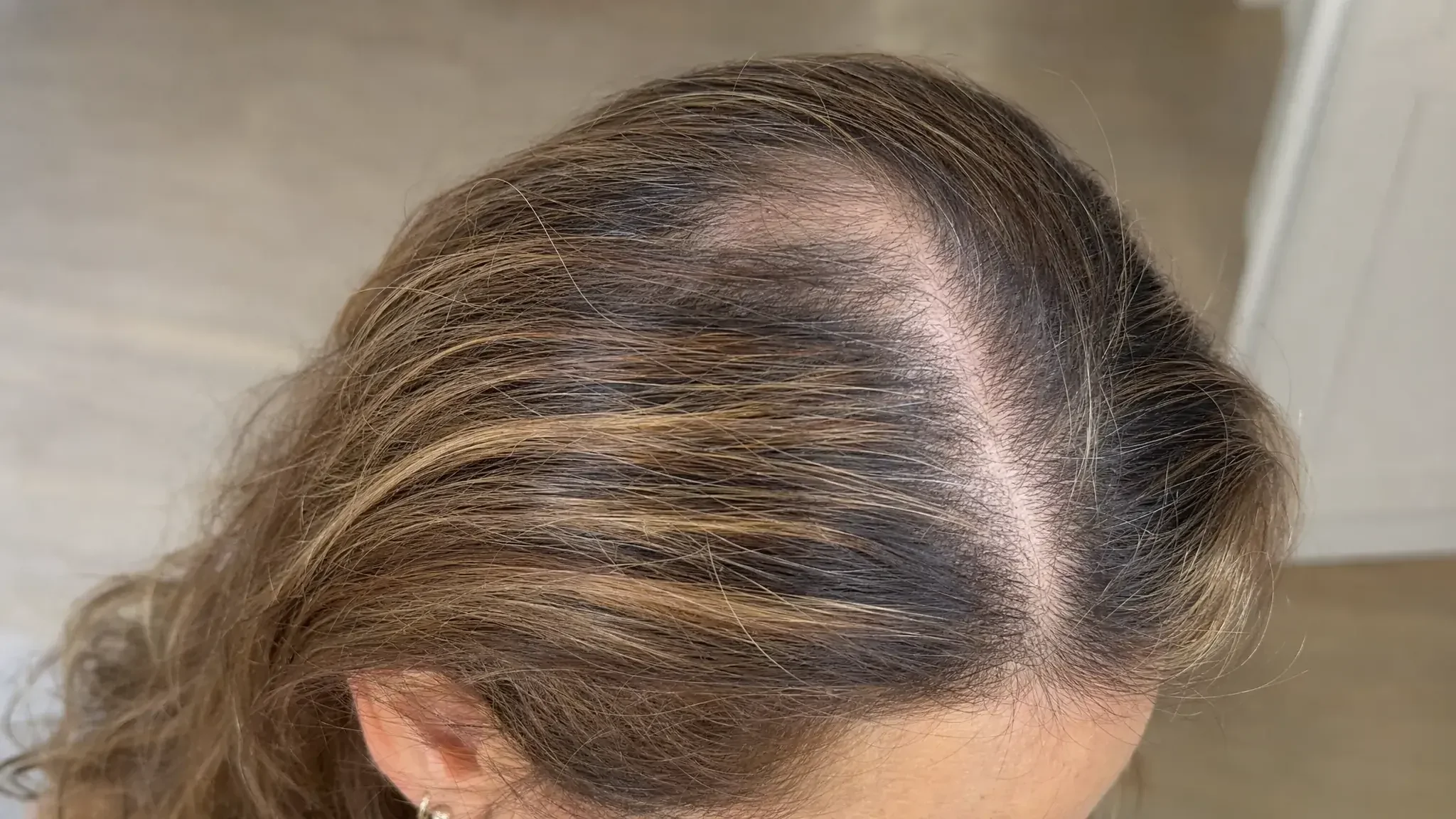 Recreación fotográfica: la densidad del cabello el día 1 del tratamiento capilar