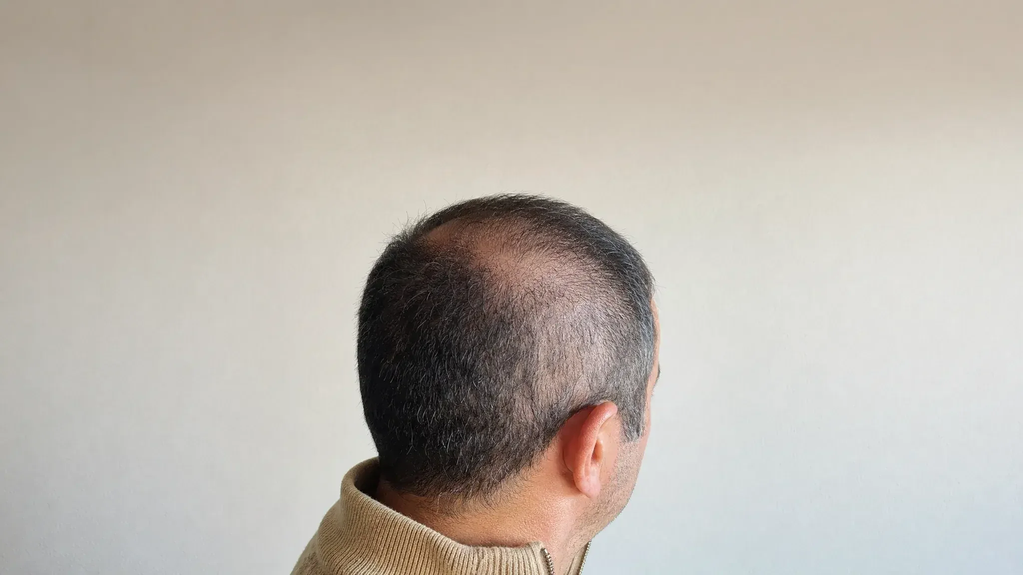 Recreación fotográfica: la densidad del cabello el día 1 del tratamiento capilar